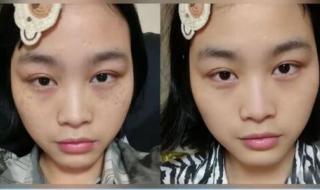 最好的去斑产品 最好的去斑产品